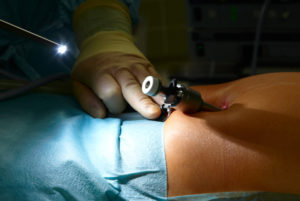 Preparing a laparoscopic surgery in a german hospital.